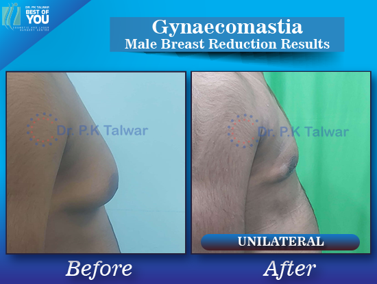 Gynaecomastia before after image